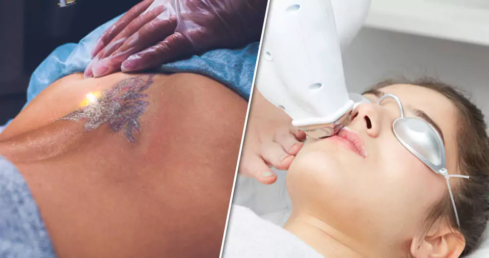What hurts more laser hair removal or tattoo removal