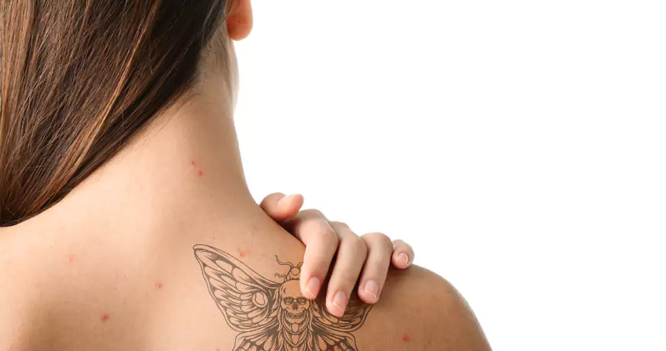 Can you tattoo over acne